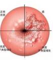 HPV和TCT之間的區(qū)別？