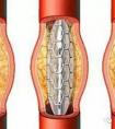 心臟支架國(guó)產(chǎn)的和進(jìn)口的有什么區(qū)別？